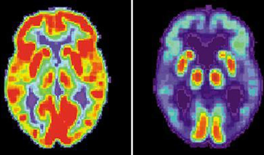 Scientists map brain network linked to addiction