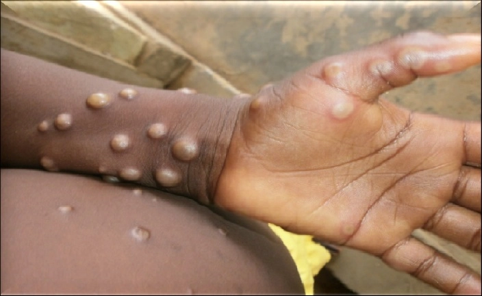 WHO approves first vaccine for monkeypox